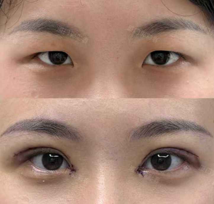 郭彩春双眼皮案例