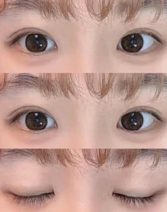 向萌娟眼修复案例