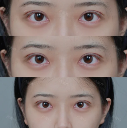 卢美均双眼皮案例