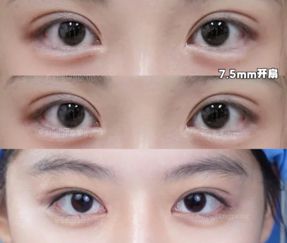 王方鹏双眼皮案例