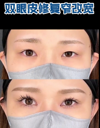 田怡双眼皮修复案例