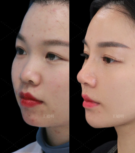 王旭明隆鼻案例