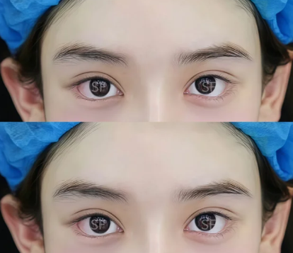 孙峰双眼皮案例