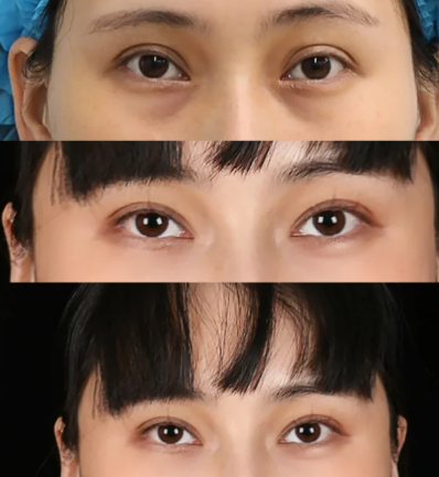 西安双眼皮修复哪个医生好?求推荐!