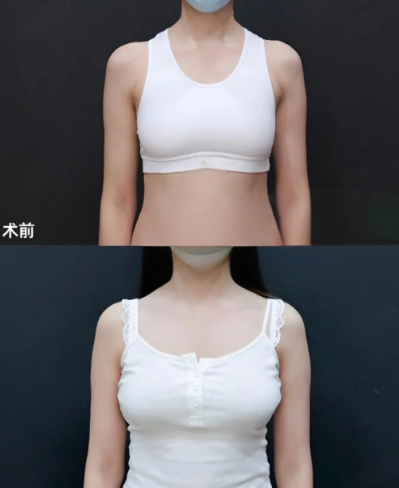 重庆假体丰胸医生哪个好?章小平和周璐珩哪个好?