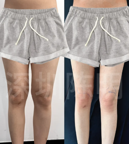 长沙吸脂陈仕文和邓旭辉哪个医生技术好?