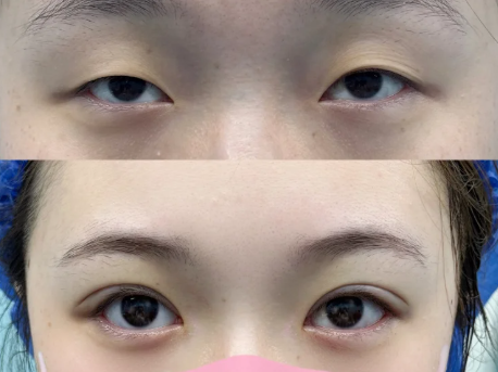 长沙双眼皮邹俊峰和罗亮哪个医生技术好?