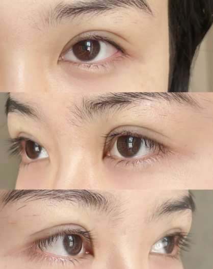 罗亮双眼皮案例