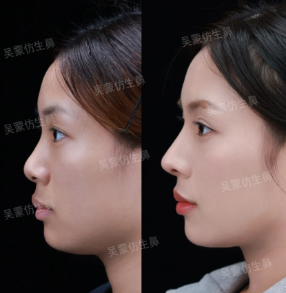 长沙隆鼻医生哪个好?吴蒙、王先成、熊宜文?