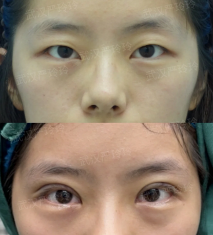 武汉双眼皮严玲玲和曹玮哪个医生技术好?