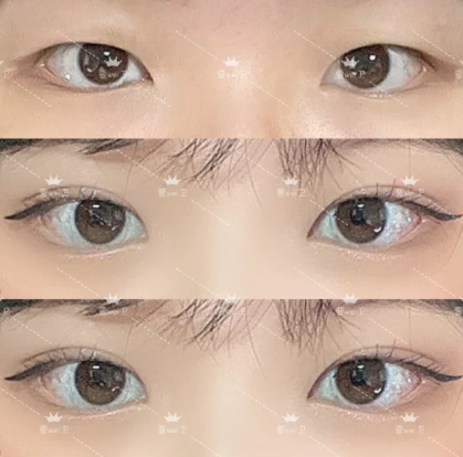 曹玮双眼皮案例