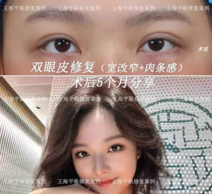 武汉双眼皮修复王海平和方涛哪个修复效果好?
