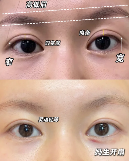 方涛双眼皮修复