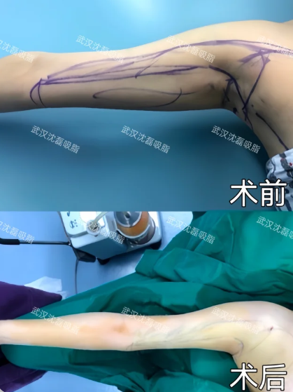 武汉吸脂哪个医生技术最好?