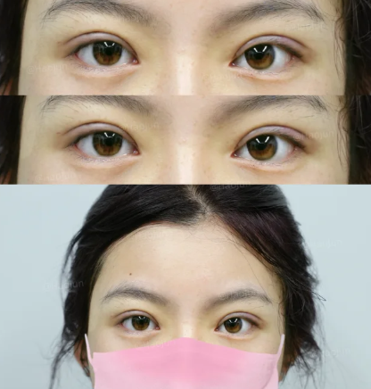 郝俊双眼皮案例