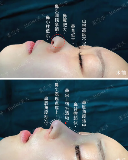 石家庄隆鼻董宏华和苏晓光哪个医生口碑好?