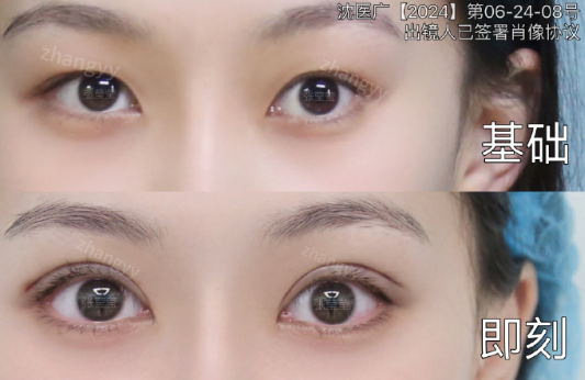 沈阳双眼皮张莹莹和王晨超哪个医生口碑好?