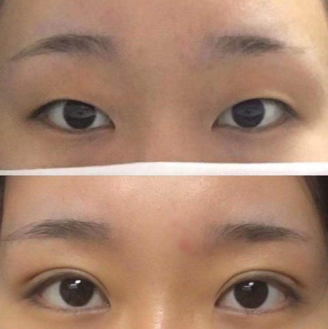 大连赵穆欣和李研哪个医生割双眼皮口碑好?