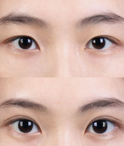 大连王洁晴和李研哪个医生做双眼皮好?