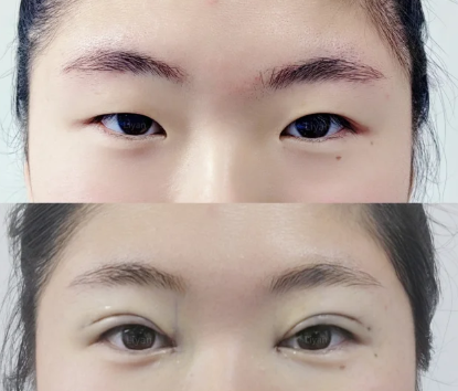 李研做双眼皮案例