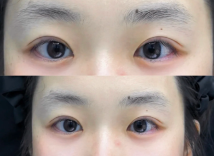 苏州秦丹莹和尹飞哪个医生割双眼皮技术好？