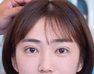 尹飞割双眼皮案例