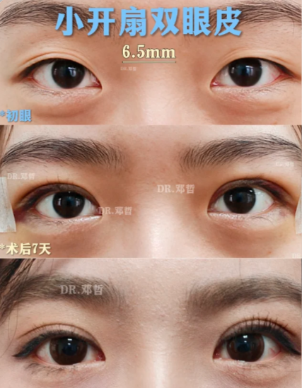 苏州邓哲和谢晓明哪个医生做双眼皮口碑好？
