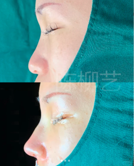 苏州隆鼻陈柳艺和张亮哪个医生口碑好？