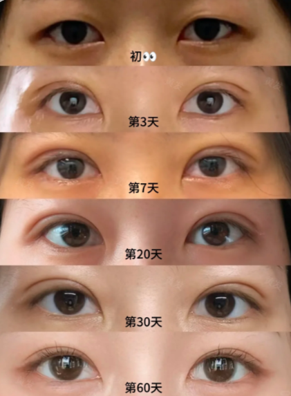 南京双眼皮医生哪个好？黄发、朱喆辰、王金明、刘宁？