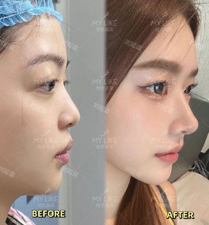 刘昭政隆鼻案例