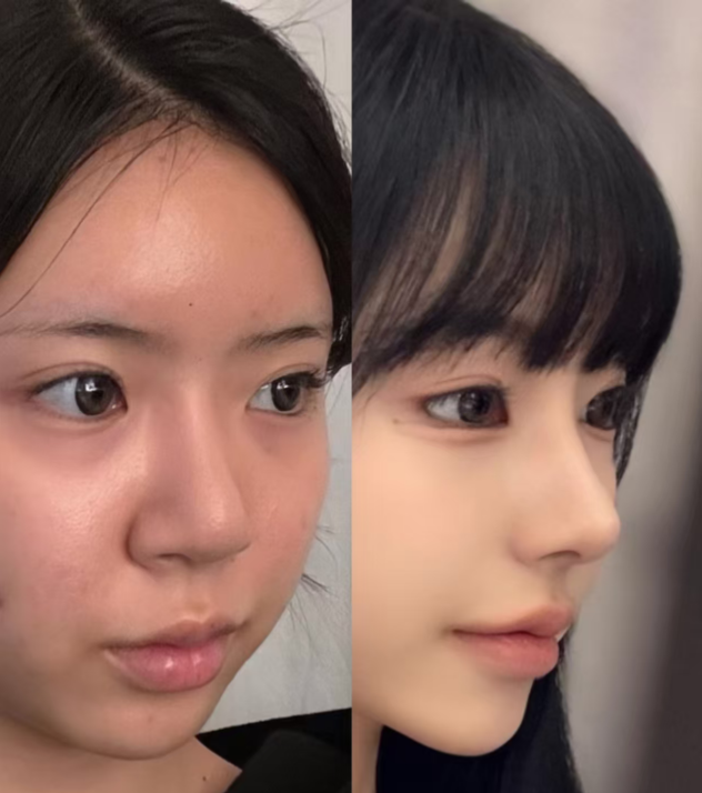 林金德隆鼻案例