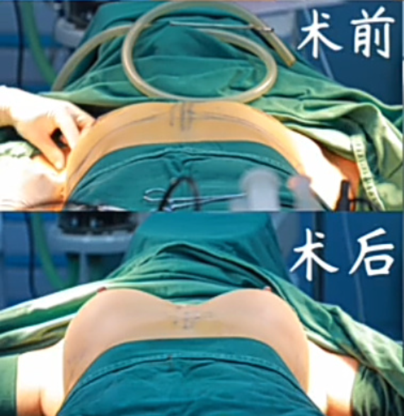 夏建军假体隆胸案例