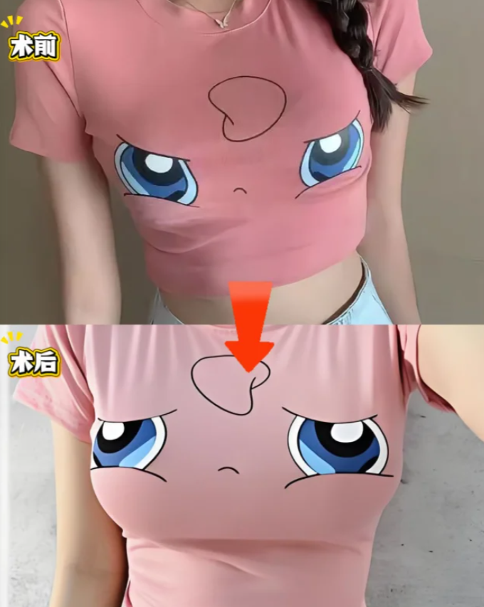 沈干假体隆胸案例