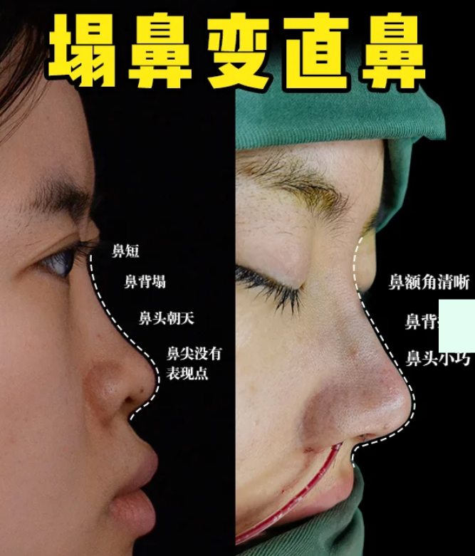 赵士俊隆鼻案例