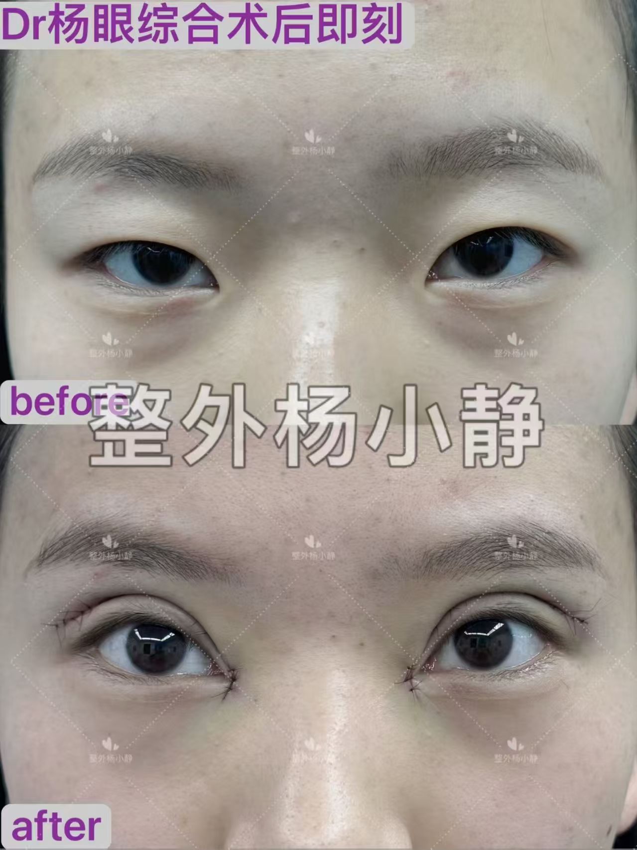 太原割双眼皮医生哪个好？杨小静和张慧华？