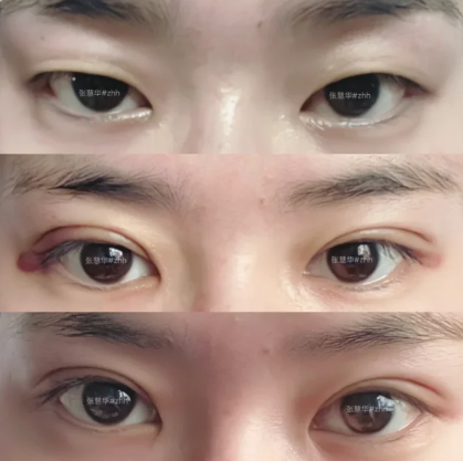 张慧华双眼皮案例