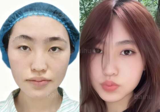 呼和浩特双眼皮医生推荐哪个？白虎和裴大伟？