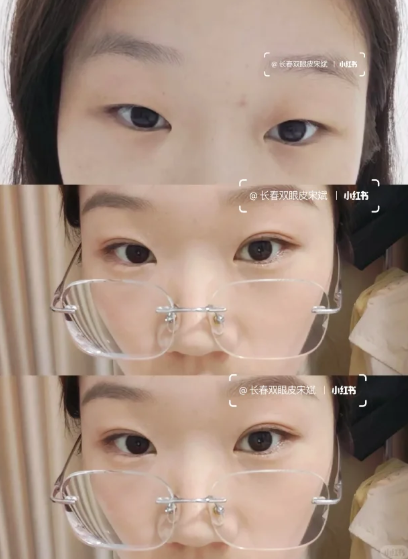 宋斌双眼皮案例