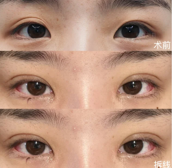 长春割双眼皮刘莉和宋斌哪个医生口碑好？