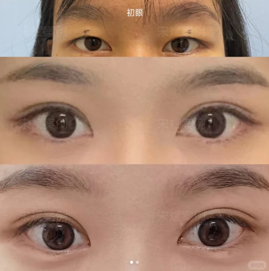 宋斌割双眼皮案例