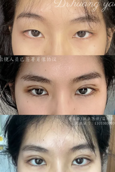 黄亚奔双眼皮案例