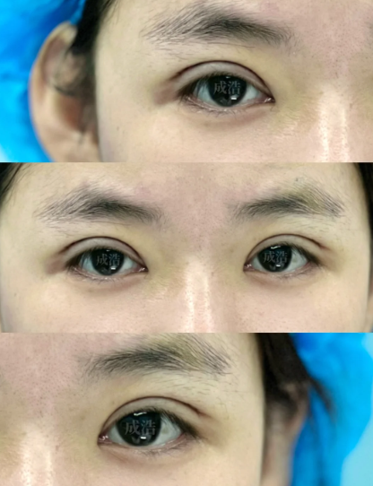 成浩割双眼皮案例