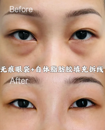 熊师祛眼袋案例