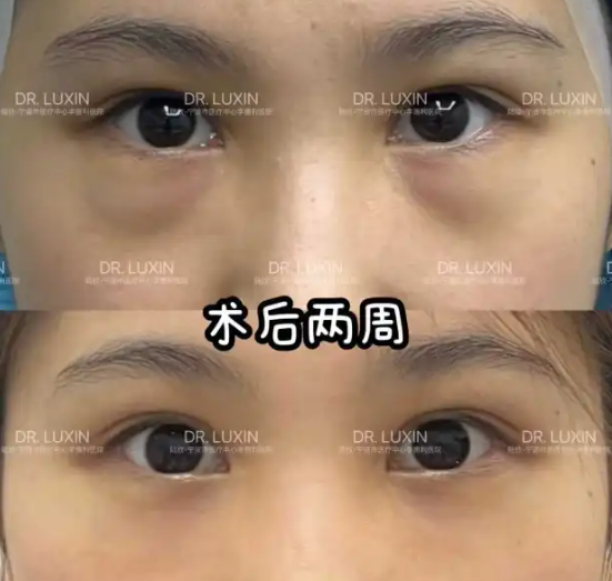 陆欣祛眼袋案例