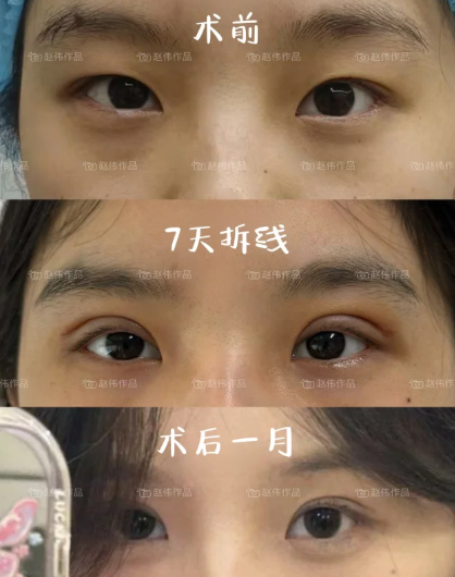 赵伟双眼皮案例