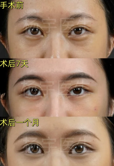 杨宇祛眼袋案例