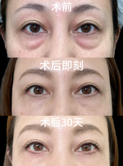 郑厚兵祛眼袋案例