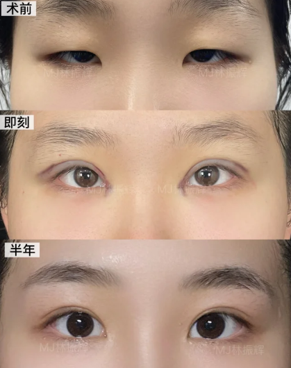 林振辉双眼皮案例