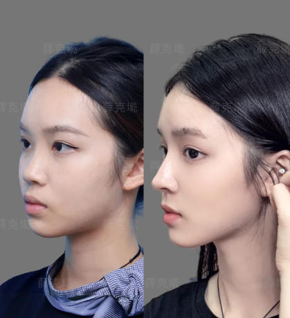 薛医生隆鼻案例