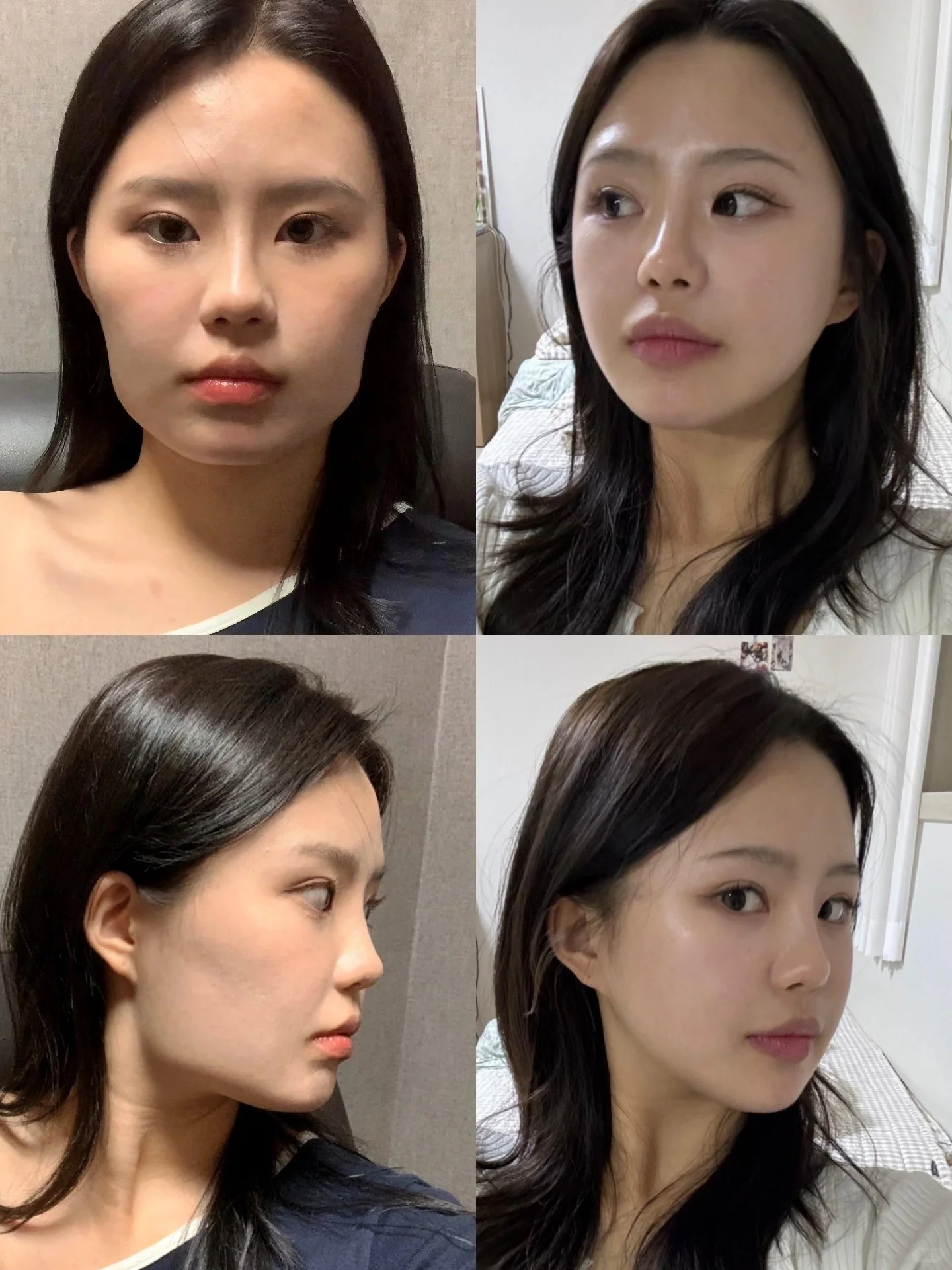 朱乐林磨骨案例